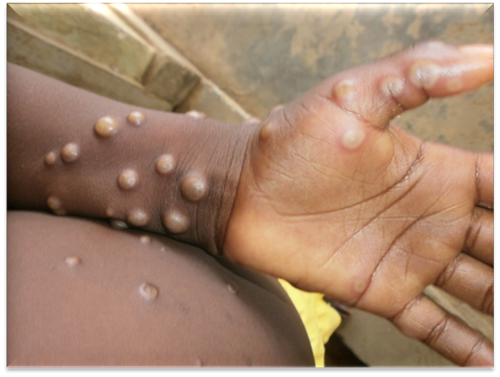 Bệnh đậu mùa khỉ ở trẻ em khá hiếm gặp và ít nghiêm trọng