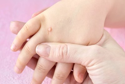 Các bệnh về da ở trẻ em thường gặp và cách phòng tránh