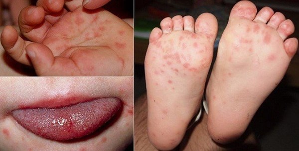 Phòng tránh bệnh chân - tay - miệng ở trẻ nhỏ  MGN B1- sưu tầm 