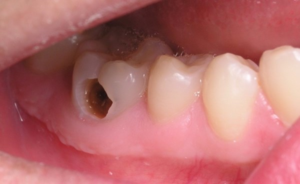 Truyền thông chăm sóc răng miệng cho  trẻ mầm non