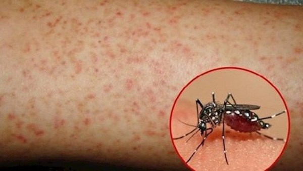 Bài tuyên truyền phòng chống dịch sốt xuất huyết