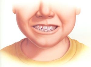 Tìm hiểu về Răng mọc lệch ở trẻ