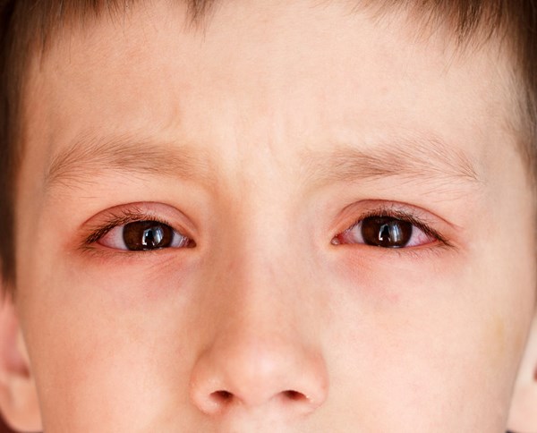 Bệnh đau mắt đỏ: Triệu chứng và cách điều trị