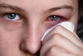 Các biện pháp phòng tránh bệnh đau mắt đỏ 