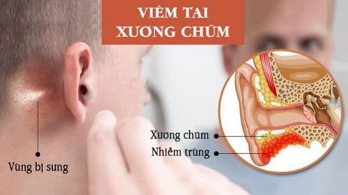 Đau tai, viêm tai giữa ở trẻ: Thận trọng với biến chứng viêm tai xương chũm cấp tính